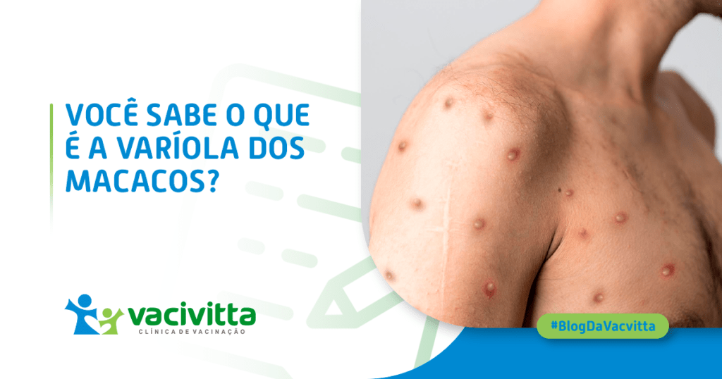 Conhecida internacionalmente como “Monkeypox” a varíola dos macacos vem causando preocupações as populações do mundo inteiro, pois a cada dia são notificados novos casos suspeitos desta doença, e no Brasil não é diferente.